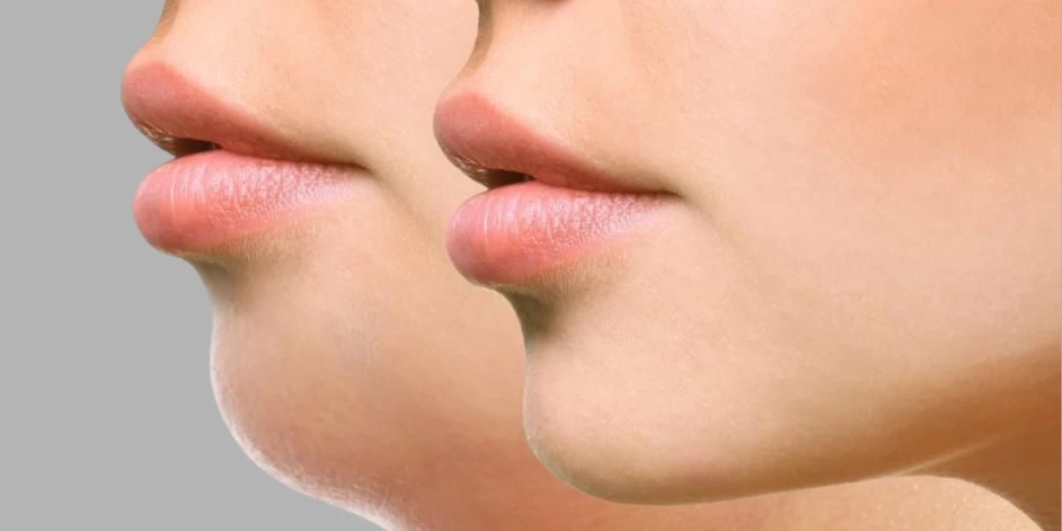 Zašto je podbradak postao najutjecajniji detalj ljepote lica i kako ga napredna estetika rješava bez noža?